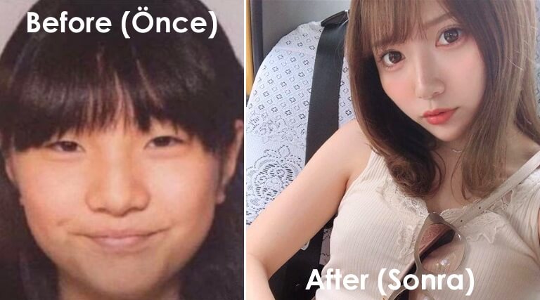 Japan Sasaeng Plastyic Surgery before after